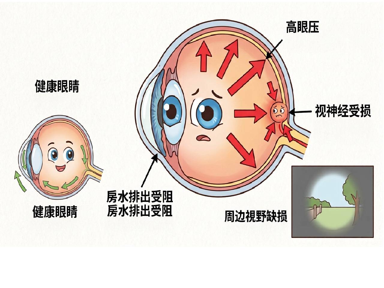 认识灵魂之窗的隐形杀手_青光眼